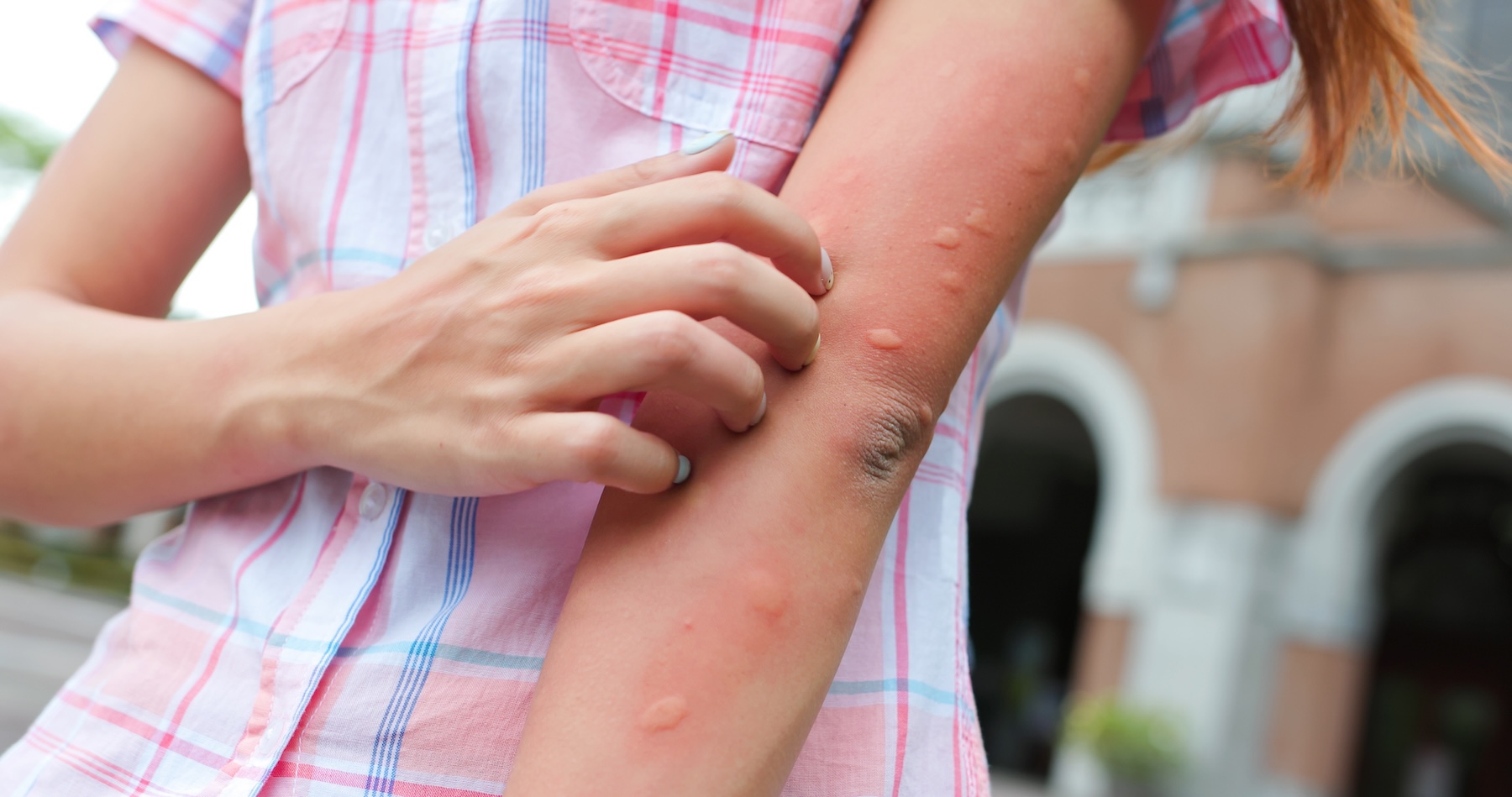 Young girl scratching her arm that is covered in hives