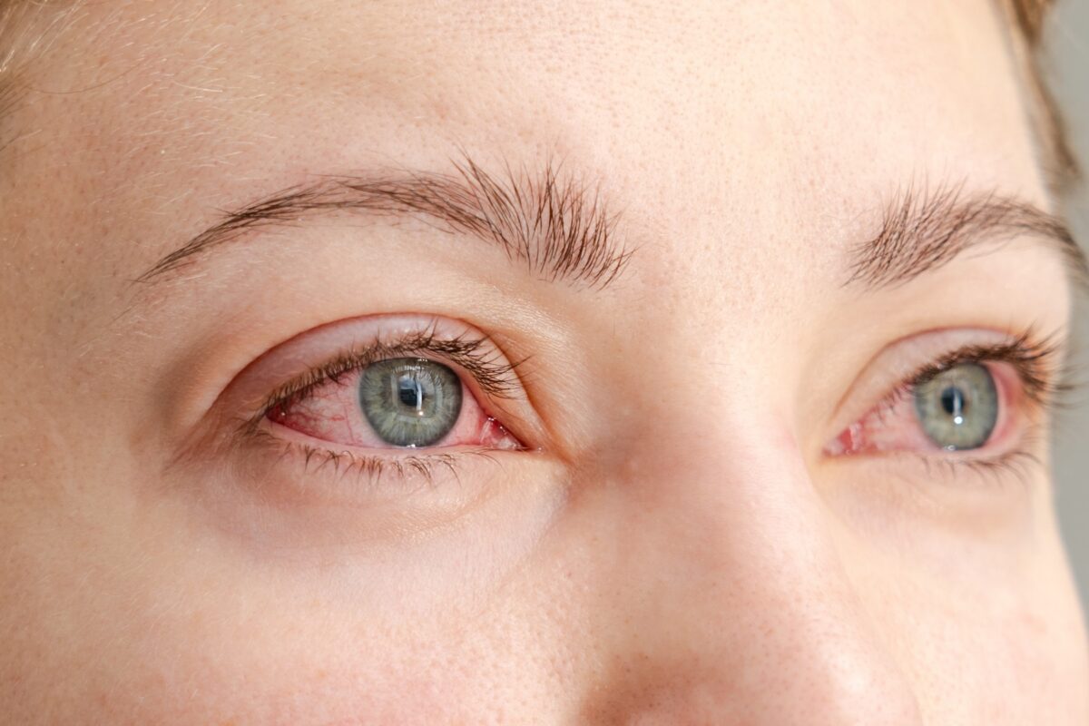 Close up of woman with red irritated eyes from an infection